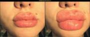 Bolted On Lips