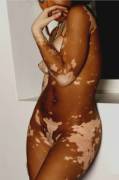 beautiful vitiligo