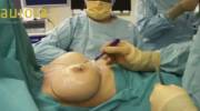 Broken breast implant (x-post from /r/WTF)