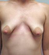 This makes me sad, it looks like a clinical shot just before "augmentation" .......