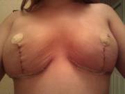 Double mastectomy